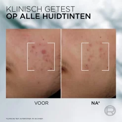 L’Oréal Paris Men Expert Derma Control Anti-Blemish Serum 30ml Tegen oneffenheden, pigmentvlekken en acne